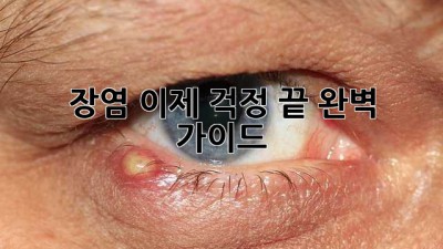 장염, 이제 걱정 끝! 완벽 가이드